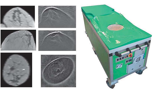 乳腺癌诊断 3D 电脑彩超