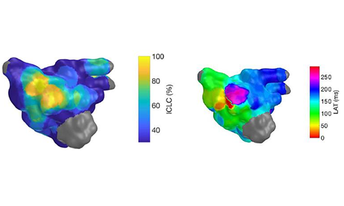 心脏按时跳动  新型诊断系统帮助确诊反复性心房扑动以及帮助应用导管消融术.